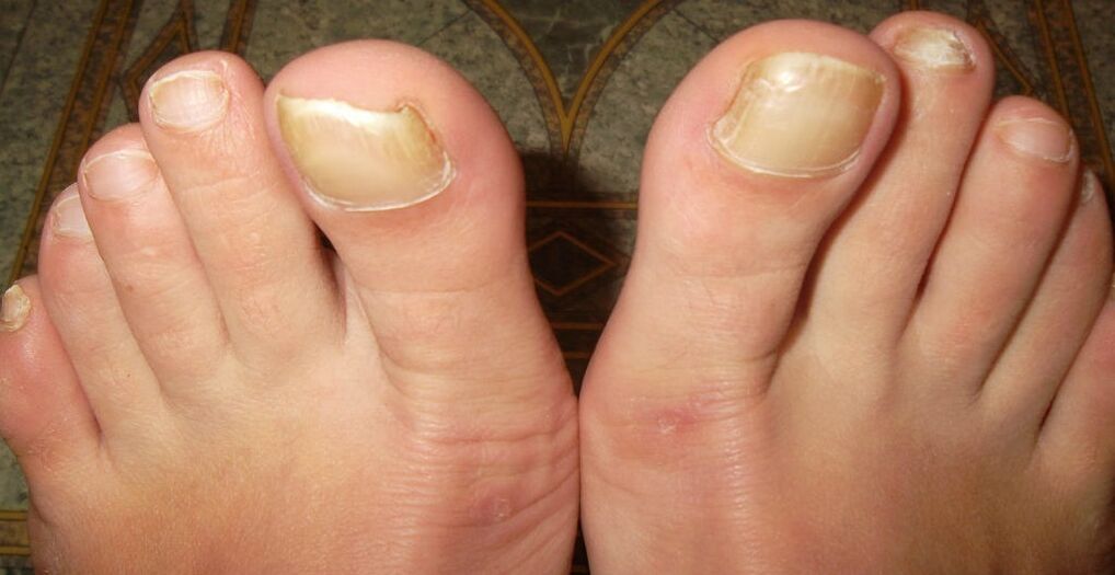 early stages of nail fungus