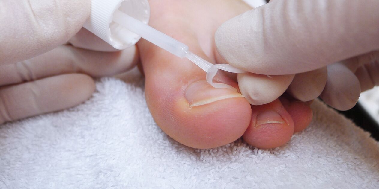 medicinal varnish against nail fungus