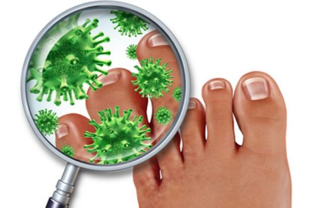 fungal infection in toenails