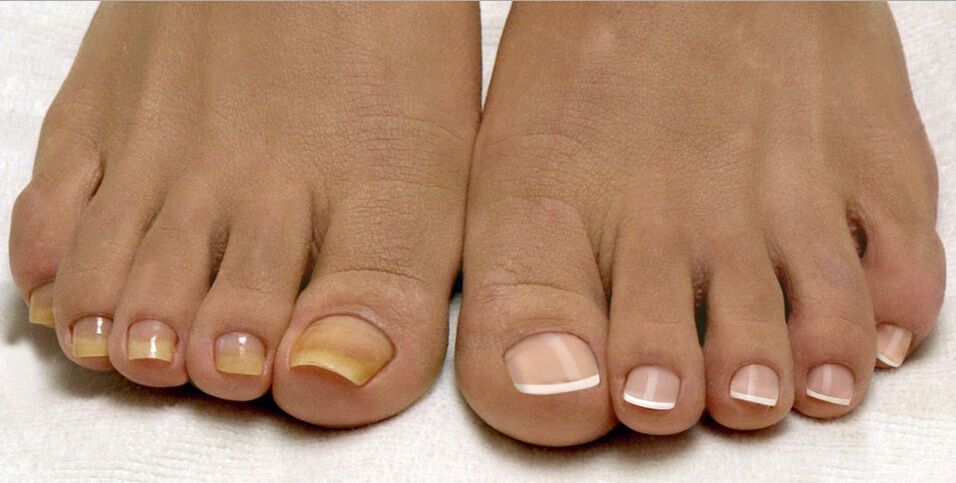 healthy nails and toenail fungus