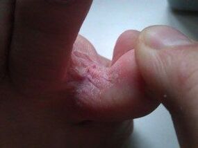 skin lesions between your toes with a fungus