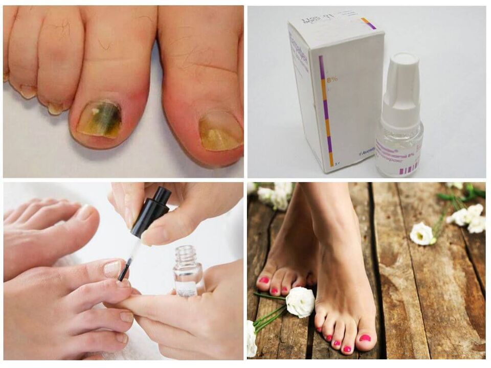 how to use nail polish against nail fungus