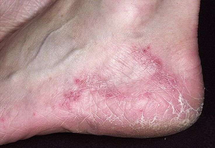 Cracks and redness on the skin of the heels are signs of a fungal infection. 