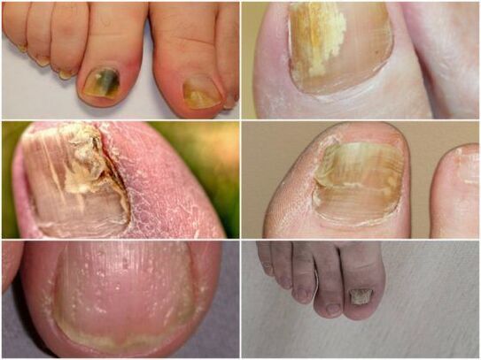 fungal nail infection symptoms