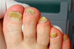 Nail fungus