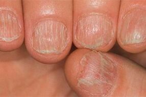 The fungus injury