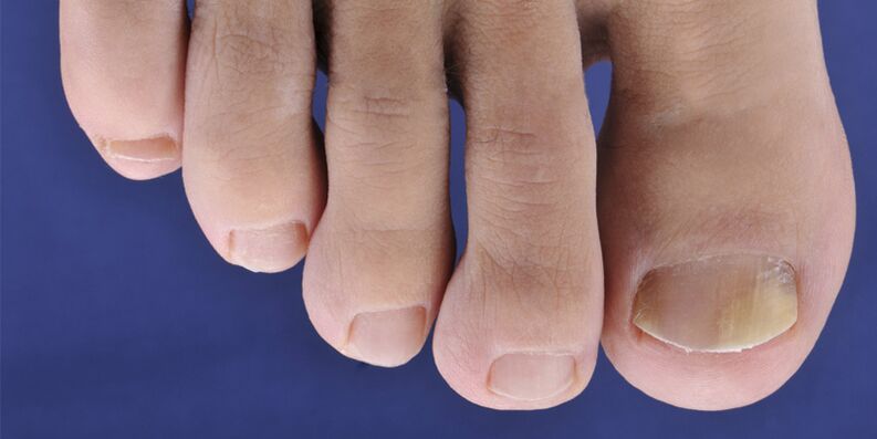 Skin ringworm symptoms and nail plates