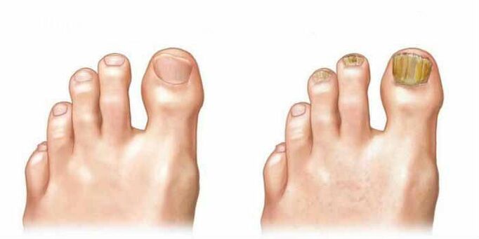 How is the fungus in the nails