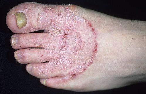 Nail feet and fungi