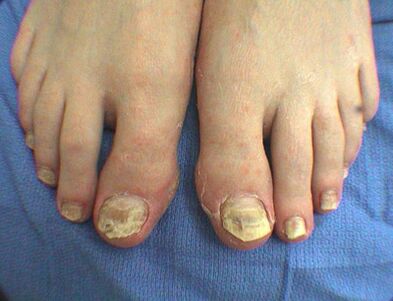 Nail fungus symptoms