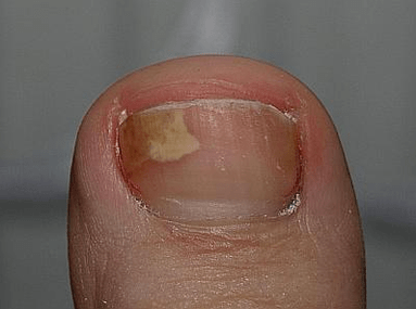 fungus on the left side of the nail