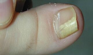 Nail fungus signs and symptoms