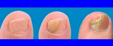 Stages of fungus development on the toes