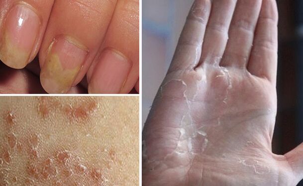 Mycosis can change to other parts of the body
