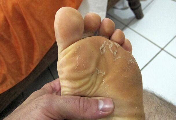fungus on the legs