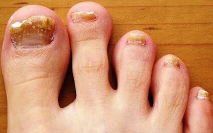 toenails affected by fungus