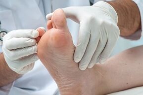 doctor examines feet for toe fungus