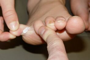 fungus on toes
