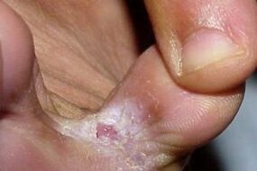 fungus symptoms between toes