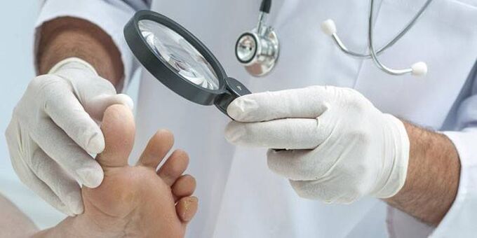 how to treat fungi