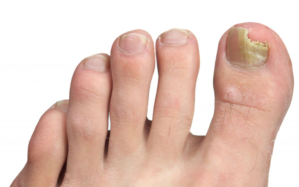 nail fungus stages