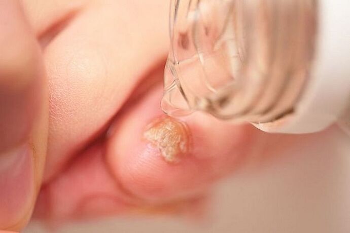 treatment of nail fungus with vinegar