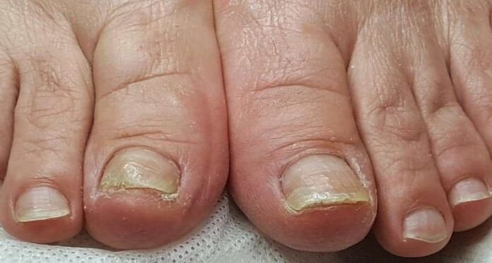 nail damage with fungus on the feet
