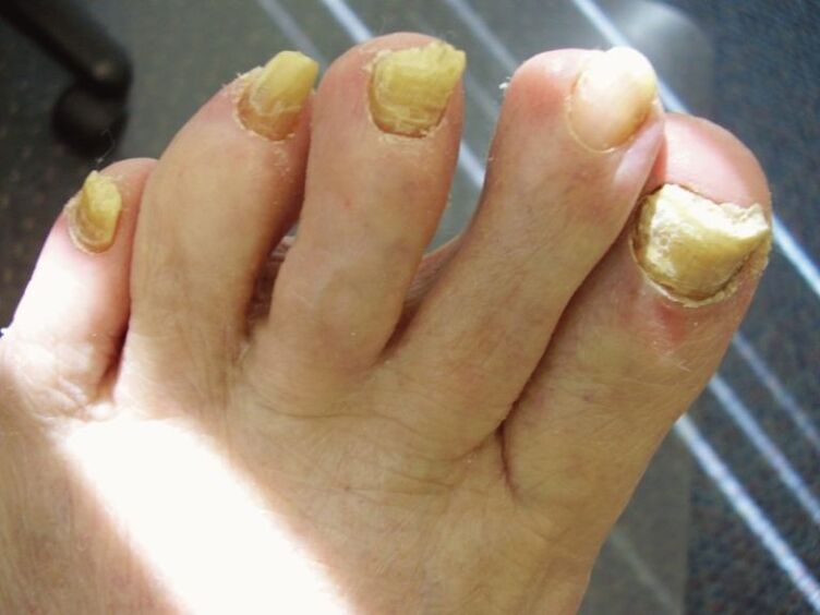 neglected nail fungus