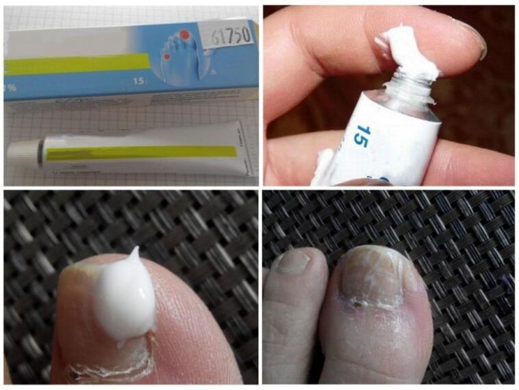 ointments against fungus on toenails
