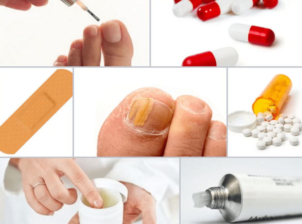 systemic medications for toenail fungus