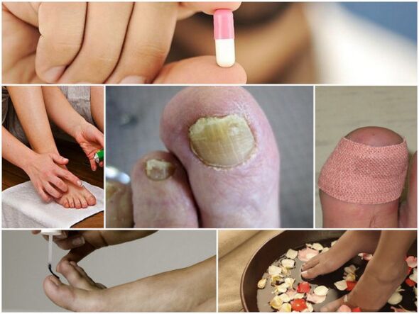 types of remedies for toenail fungus
