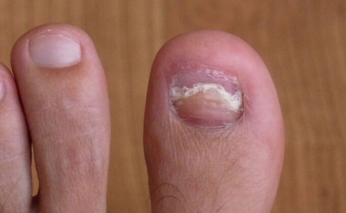 damage to the toenail with a fungus