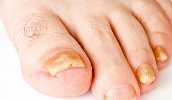yellow nails for yeast infections