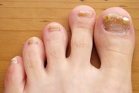 nail fungus