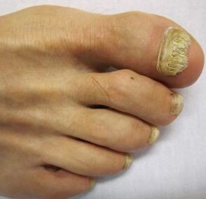 advanced stage of toenail fungus