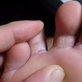 crack between toes fungus symptoms